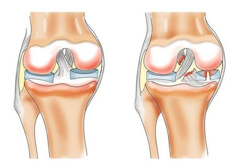 healthy knee and knee arthrosis