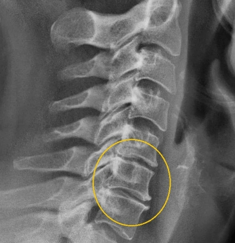 cervix osteochondrosis
