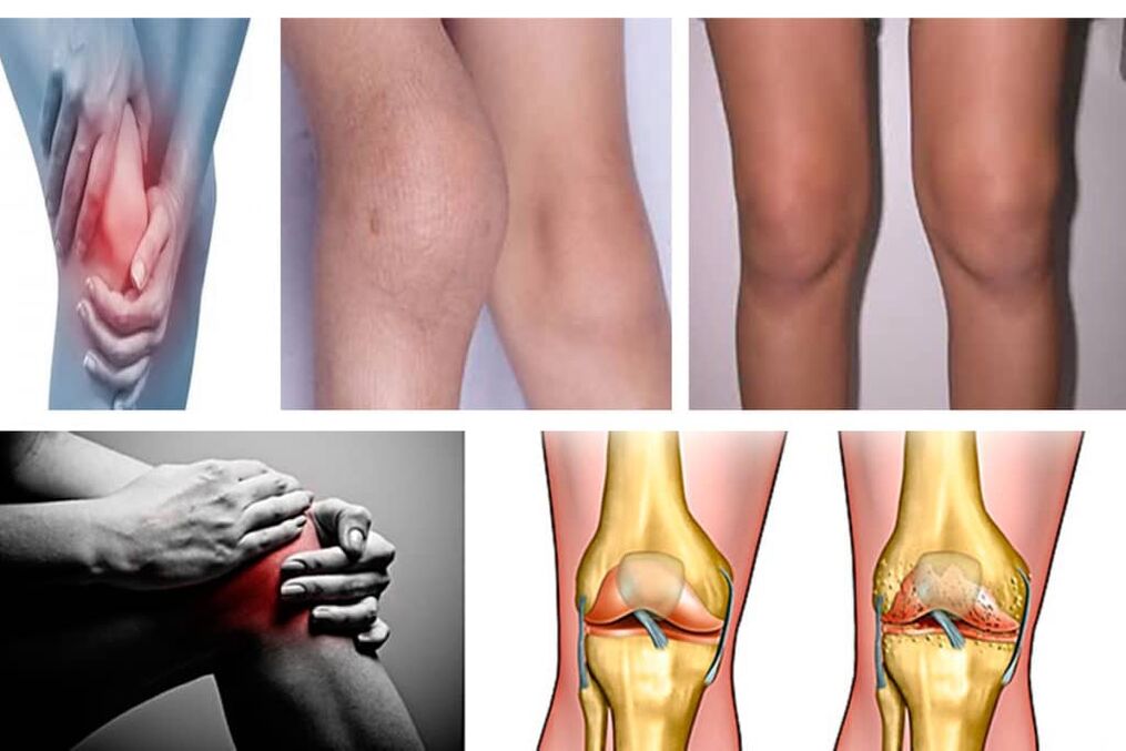 The joint symptoms of the knee